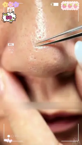 028 Saya selalu pakai! Kalau ada komedo hitam dan putih di wajah, wajib coba jarum jerawat ini! Efeknya mantap banget! Jangan lewatkan penawaran spesial ini!