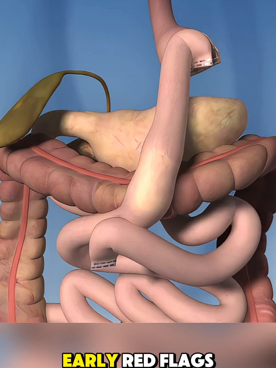 Gastric Bypass Surgery _ Symptoms (3D Animation) #3dmedicalanimation  #medical3danimation  #gastricbypass  #signsyoushouldntignore #MedicalAwareness 
