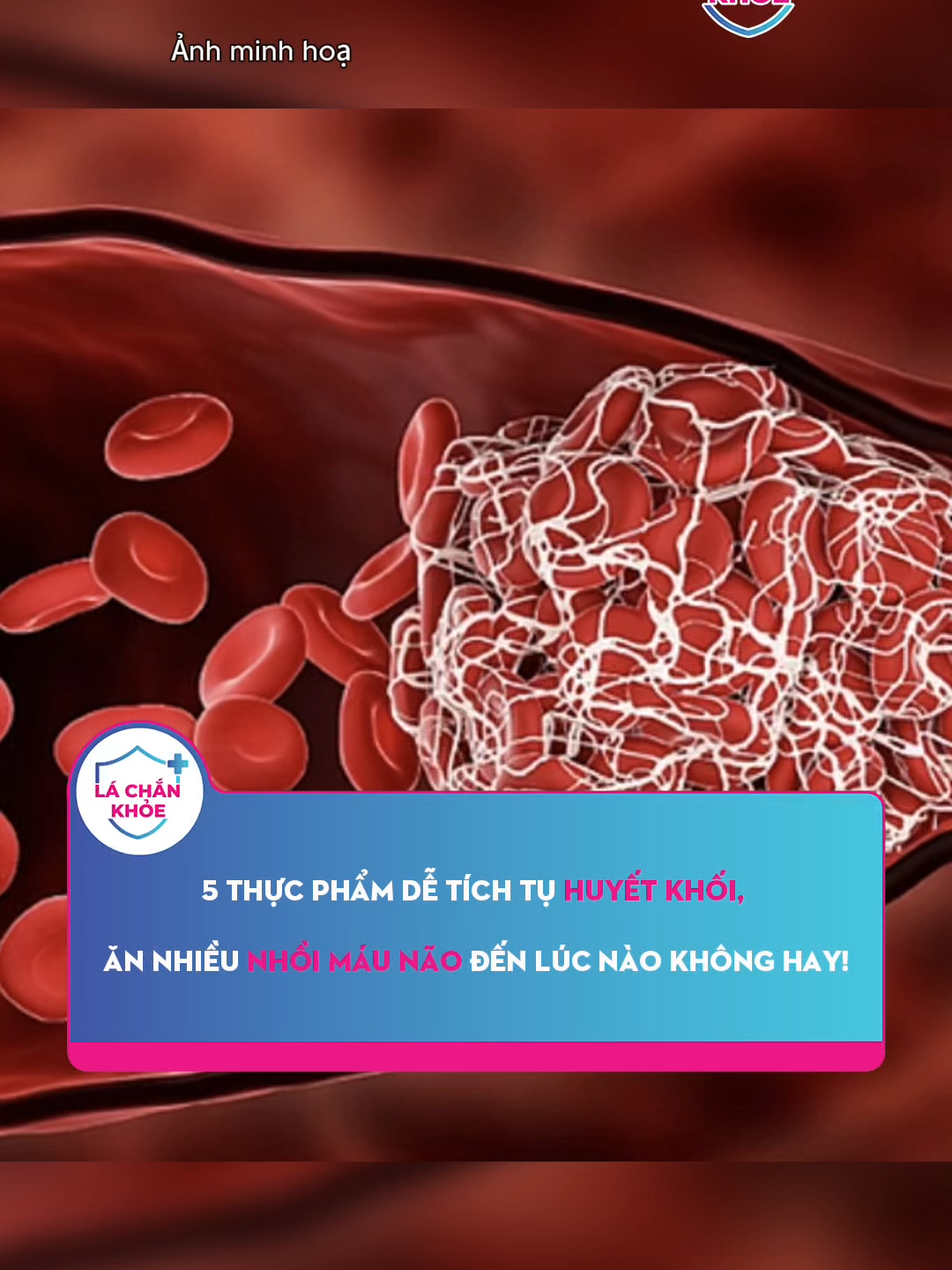 5 thực phẩm dễ tích tụ huyết khối, ăn nhiều nhồi máu não đến lúc nào không hay! #lachankhoe #SongKhoe247 #LearnOnTikTok #xuhuong