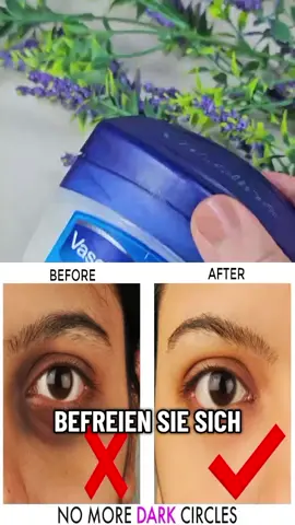 Das hat mein Gesicht in 24 Stunden verändert. (Augenringe verschwunden) Schluss mit dem Scrollen! Das beseitigt Ihre Tränensäcke in einer Nacht (Im Ernst!) #skin #skincare #skincareroutine #beauty #beautytips #beautyhacks #women #woman #girls #girl #darkcircles #darkcirclesundereyes #puffyeyes #undereyebags #Recipe #recipes #recipesoftiktok #remedy #remedies #naturalremedies #DIY #fyp #foryou #foryoupage #videoviral #viral #germany #deutschland #deutsch #austria #suisse #hausmittel #rezept #gesundheit 