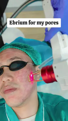 ini video kemarin ya trifill pro max + ebrium laser..saya coba ebrium laser yg low ya karena habis treatment trifill pro max, jadi ga berani yg terlalu strong soalnya anestesi nya Uda habis🤣🤣, tp ebrium bisa buat bopeng tipis juga ya bahkan icepick bisa ngebantu kalau lasernya strong #scar #bopeng #treatmentbopeng #ebriumlaser 