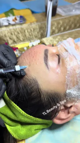 Run ttay = Rejuran HB #tl_beauty_spa #Meso_căng_bóng_trắng_sáng #meso_phục_hồi #tiêm_meso #xh 