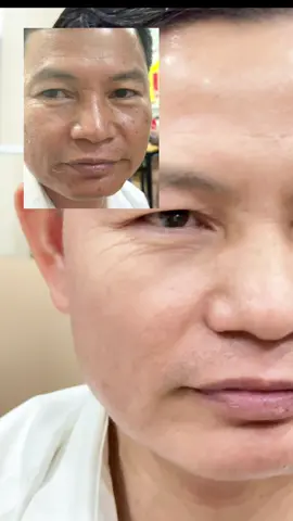 Da chồng em  sau peel phác đồ nám trẻ hoá#peelda #spa #đàotaohocvien #xuhuongtiktok 