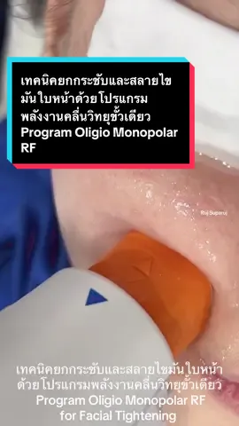 เทคนิคยกกระชับและสลายไขมันใบหน้าด้วยโปรแกรมพลังงานคลื่นวิทยุขั้วเดียว Program Oligio Monopolar RF for Facial Tightening  • เทคนิคที่หมอชอบคือ การใช้สองพลังงานร่วมกันคือคลื่นวิทยุ Monopolar RF ร่วมกับโปรแกรมยกกระชับอัลตร้าชาวน์ Macro and micro focused ultrasound MMFU โปรแกรม Ultraformer MPT เพื่อเสริมประสิทธิภาพกันครับ โปรแกรม #oligio #monopolarrf โปรแกรม#ยกกระชับใบหน้า #หน้าเรียวโปรแกรม #โอลิจิโอ้  #สลายไขมันแก้ม  @Ruj Suparuj 