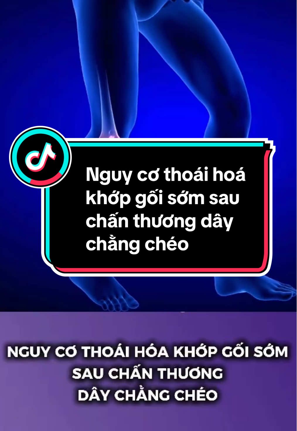 Chấn thương dây chằng chéo khớp gối là một trong những tổn thương nghiêm trọng nhất ảnh hưởng đến sự ổn định và chức năng của khớp gối. Đặc biệt, nếu không được điều trị đúng cách và kịp thời, chấn thương này có thể dẫn đến những hậu quả lâu dài, trong đó thoái hóa khớp sớm là một trong những biến chứng phổ biến nhất. Đối với những bệnh nhân chấn thương dây chằng chéo có chỉ định phẫu thuật, bác sĩ có thể tiêm thêm Collagen thủy phân Arthrys Regain ngay sau phẫu thuật nhằm chống viêm giảm đau, giúp bệnh nhân sớm tham gia tập phục hồi chức năng và quay trở lại sinh hoạt bình thường. #collagenthuyphan #collagenthuyphanarthrys #collagenthuyphantiemnoikhopduynhat #chanthuongdaychang #tiktok 