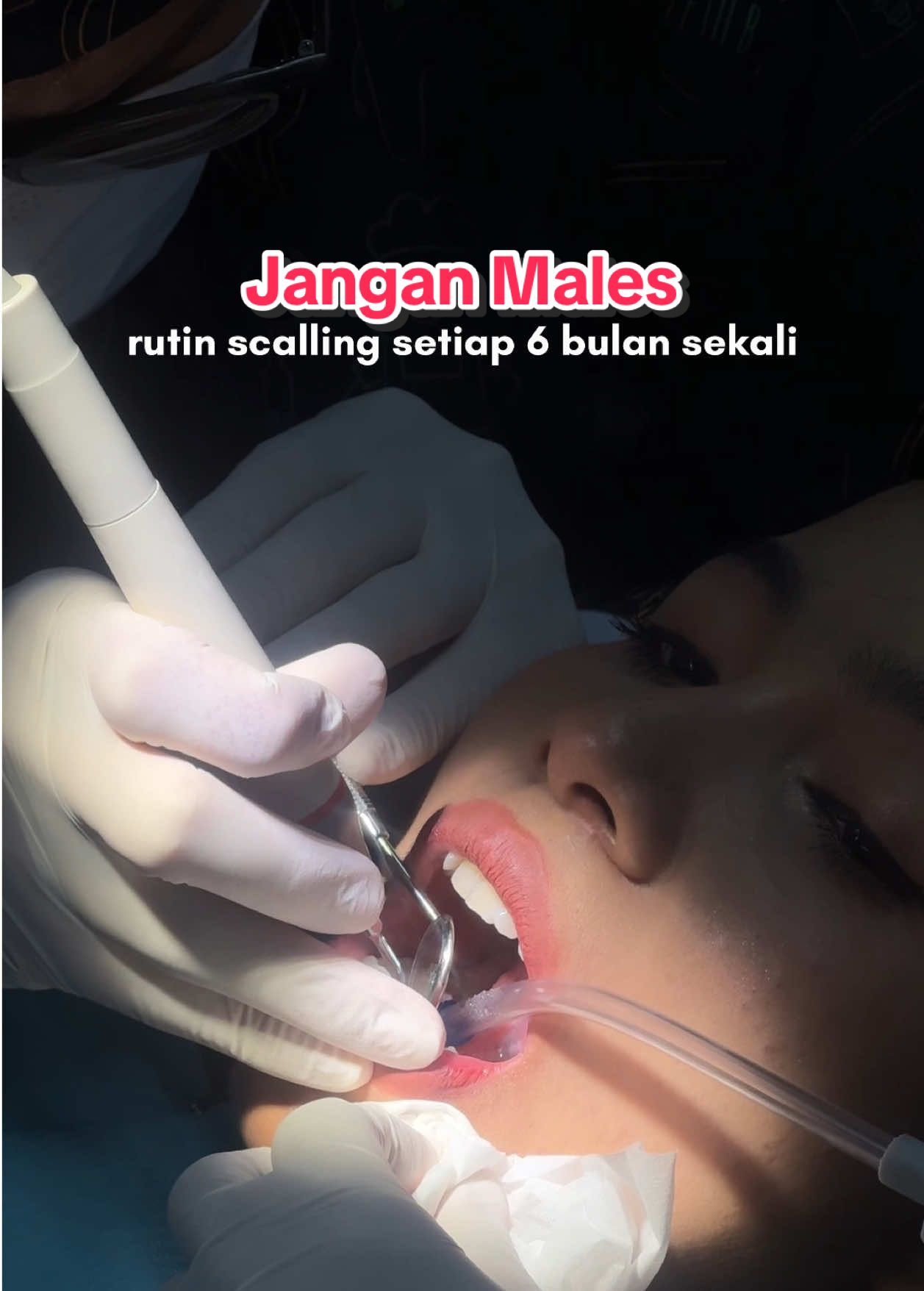 Pleasee kalo males scaling minimal jangan males gosok gigi😤  #versident #versidentshinningbrightteeth #pemutihgigi #karanggigi #solusigigikuning @Versident 