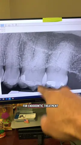 Mb2 addressed through the MB1. #dentists #rootcanal #dentistry #dentalstudent #dentalhygienist 