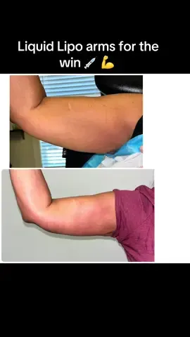 Liquid Lipo Treatment Areas! 💊💫  Common areas to target: ✨ Double chin ✨ Love handles ✨ Belly fat ✨ Bra bulge ✨ Back fat ✨ Arms Which area would you like to contour? 💬  #LiquidLipo #BodyContouring #fatdissolving #bodysculpting #softlifemedspaandwellness #MedSpaTreatments 