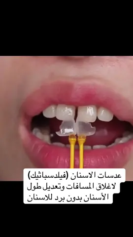 عدسات الاسنان (فيلدسباثيك) لاغلاق المسافات وتعديل طول الأسنان بدون برد للاسنان #اسنان #هوليود_سمايل #ت#رياض #اسطنبول 