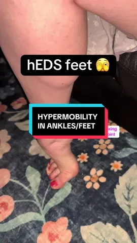 Wait for the ending 😅 Yes, I know my feet are gross. #hypermobileehlersdanlossyndrome #heds 