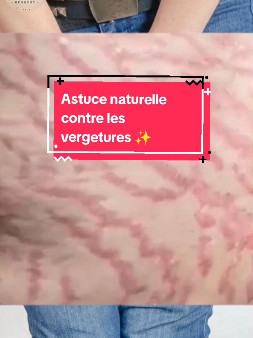 Astuce naturelle contre les vergetures ✨ Découvre un gommage maison simple et rapide (sel + sucre + café) pour réduire les vergetures après l’accouchement ou un changement de poids. Exfolie, hydrate et redonne élasticité à ta peau — idéal pour les jeunes mamans post-partum 💕. Aime et partage pour aider d’autres mamans 🌸 #vergetures #postpartum #gommagemaison #soindelapeau #RecetteNaturelle 