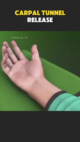 Carpal Tunnel Release Surgery (3D Animation) #carpaltunnel #carpaltunnelsyndrome #carpaltunnelrelief #carpaltunnelsurgery #carpaltunnelrelease 