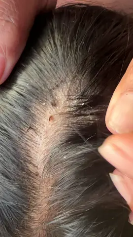 #omg #lice #liceremoval 🥶🥶🥶 #amazigh #tiktokindia 