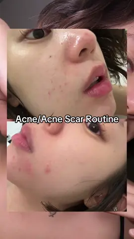 recent skincare routine for acne using @rovectin_us @Rovectin 💛