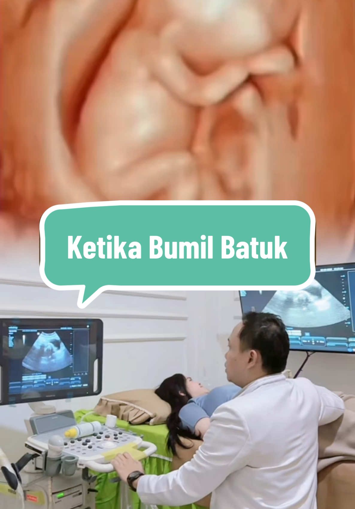 Gambaran tingkah lucu sikecil dalam kandungan saat bumil batuk 😁 #dokterkandungan #usg #usg4d #bumilbatuk #batuk 