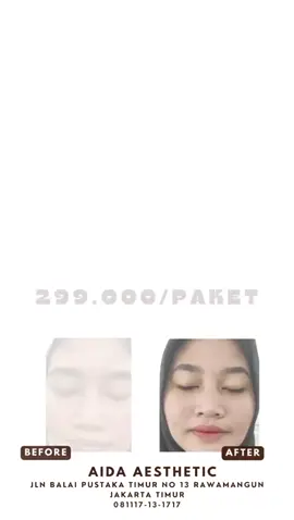 📢 *DOUBLE TREATMENT HANYA 299.K*‼️ Hanya Di *AIDA AESTHETIC* Treatmentnya super terjangkau dan hasilnya tidak pernah gagal karna di *Aida Aesthetic* Selain banyak Promo dipastikan kalian pulang treatment mendapatkan produk After treatment di rumah untuk menjaga Hasil lebih maksimal  HANYA 299.000 Dapatkan Rangkaian Treatment lengkap Hasil maksimal  🥰🥰🥰🥰 Payment 299.000 Dapatkan: • FACIAL BASIC ✅ • ⁠IPL ✅ • ⁠PEELING ACNE / WHITENING ✅ • ⁠PRODUK AFTER CARE ✅ 📍Aida Aesthetic  Jl. Balai Pustaka Timur No 13 Rawamangun Jakarta Timur  081117-131717 #hargaterjangkau#hasilmemukauhargaterjangkau #klinikkecantikan #perawatanwajah #rawamangunkecantikan 
