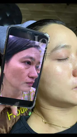 Cập nhật da sạm #chamsocdaseo#chamsocda#chamsocdamun#chamsocdanam#tanbinh     