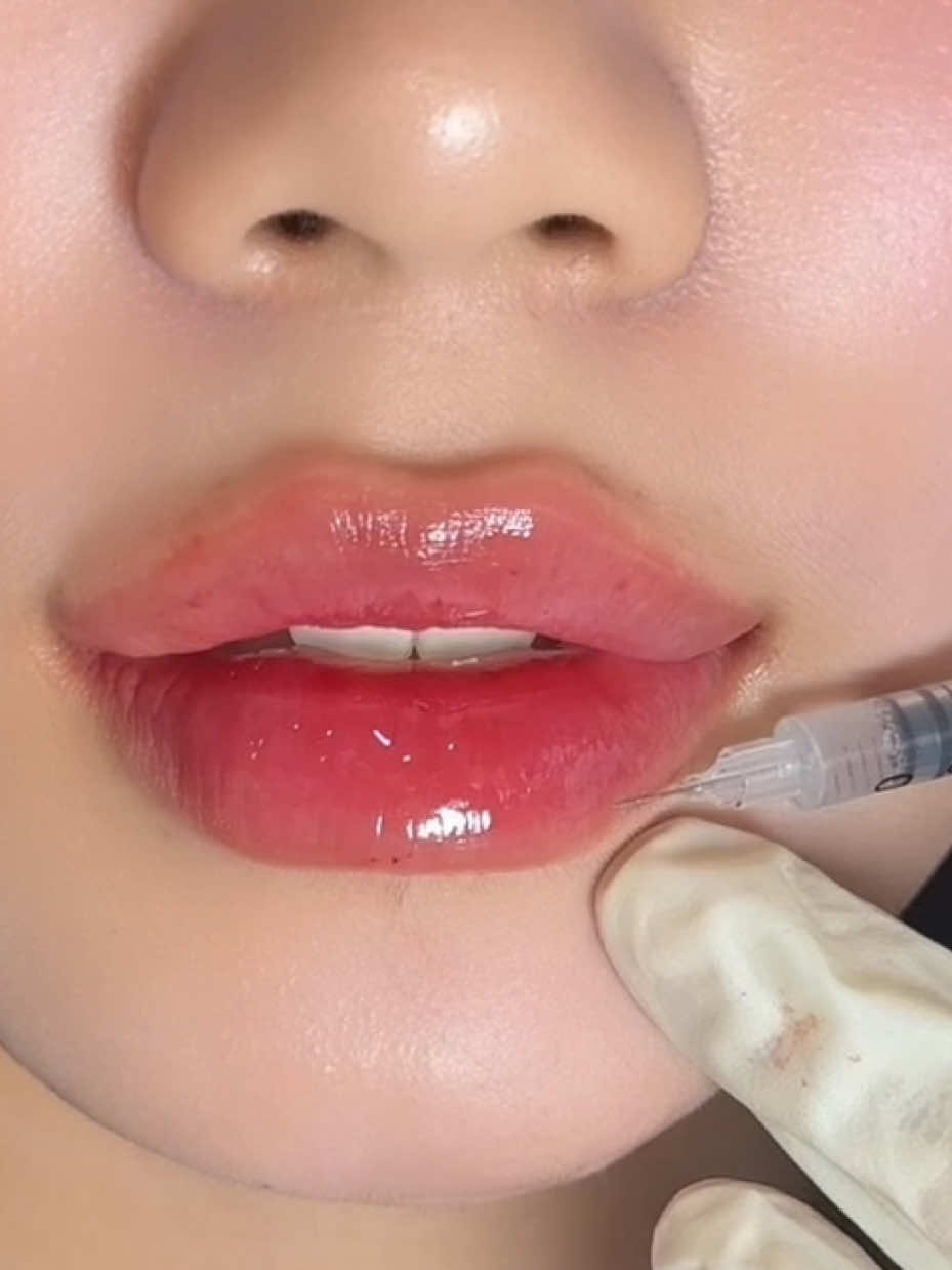 Bà nào chán môi baby thì có thể tham khảo dáng này nha #babytay #môi #filler #tiêmmoi 