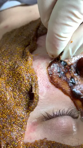 Xịn#lấynhanmunbangtay#chamsocdamun#chamsocdaseo#chamsocdanam#tanbinh    &Acedemy