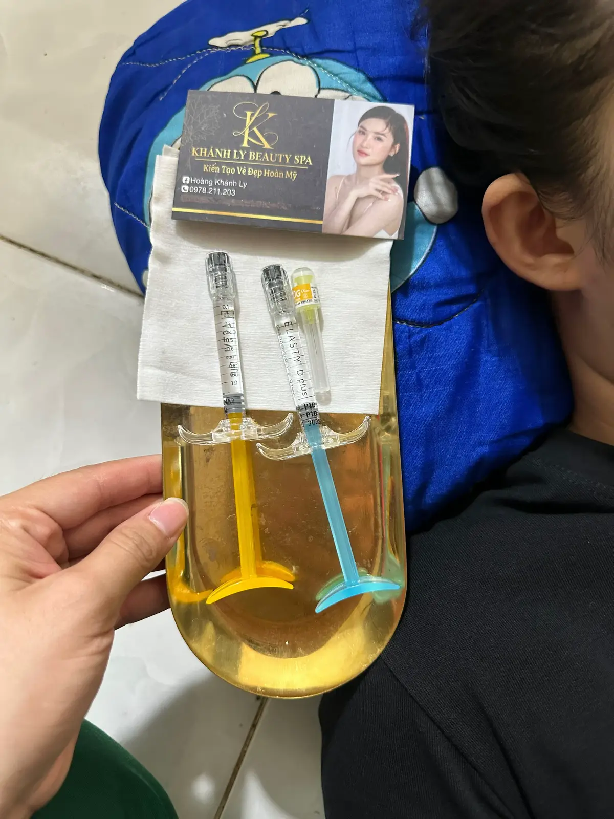 Case “CÂN CHỈNH MÔI + CẰM” tại nhà cho chị khách ở Thuận Giao ngày mưa❤️ #xuhuong2025 #lamdeptainha #khanhlybeauty #viral 