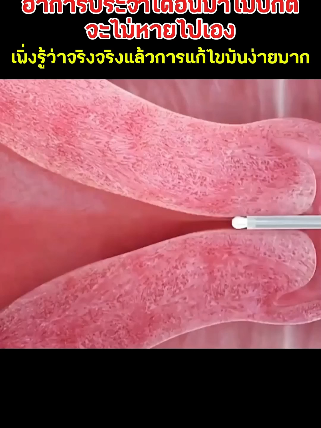 พุงล่างยื่น ออกกำลังกายยังไงก็ไม่หาย สาเหตุอาจเพราะมดลูกไม่สมดุล แค่ใช้สิ่งนี้ เห็นผลใน 7 วัน! #อากาศเย็น #ท้องอืด #ประจำเดือนผิดปกติ