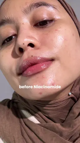 fade dark spot in 7 days! product : KSECRET SEOUL 1988 Glow Serum : Niacinamide 15% + Yuja  @KSECRET GLOBAL  #KSECRETGlowChallenge #KSECRET #Seoul1988 #DarkSpots 