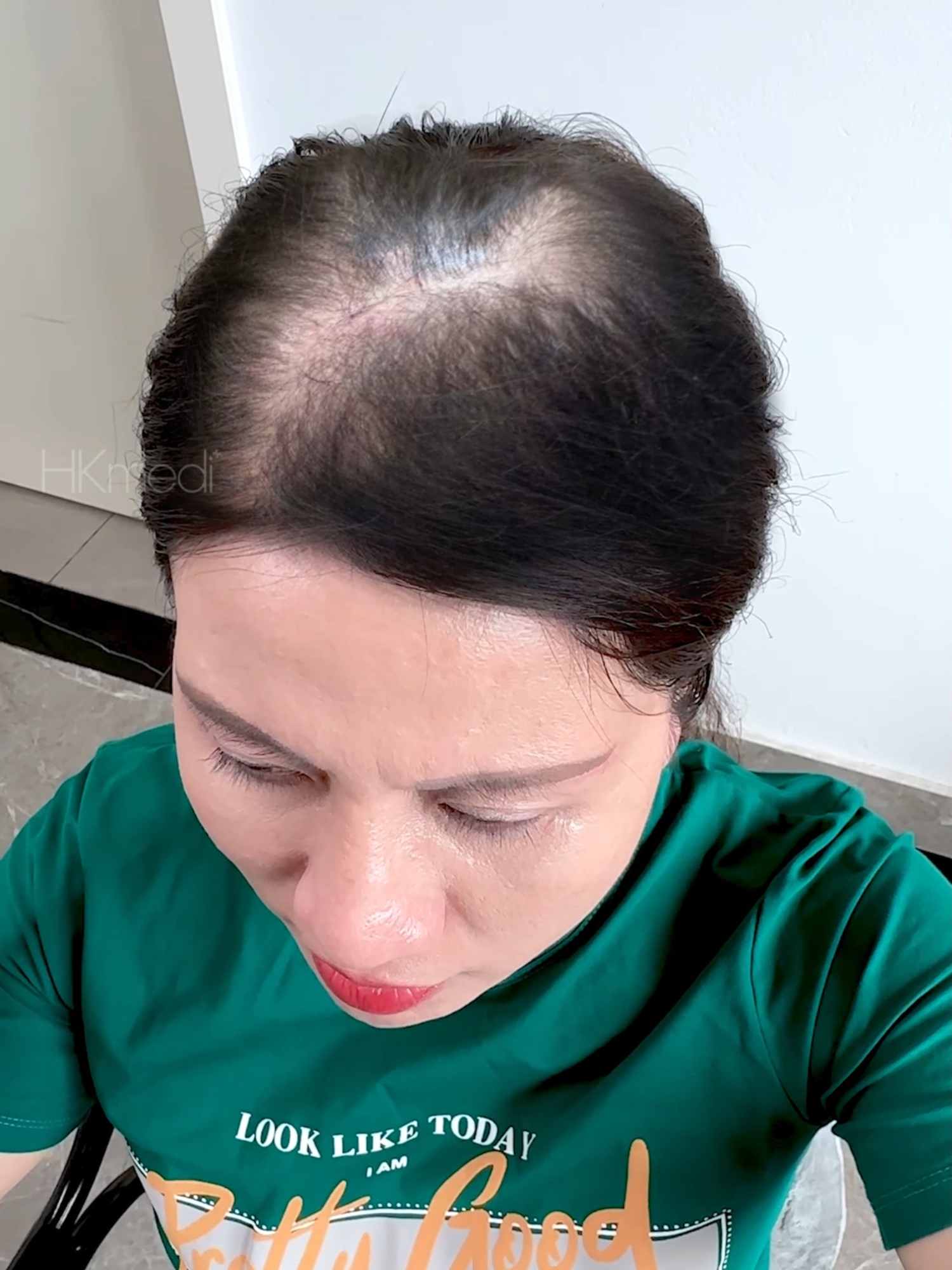 42 NỒI BÁNH CHƯNG CHỊ THUÝ NGÂN MỚI CHỨNG KIẾN MÁI TÓC CỦA MÌNH DÀY VÀ DÀI ĐẾN VẬY! >> Phác đồ cá nhân hóa được xây dựng cho từng khách hàng 👉 Gửi ngay tình trạng tóc hiện tại qua inbox để được tư vấn phác đồ điều trị phù hợp!