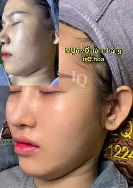 Lột xác#chamsocdaseo#chamsocda#chamsocdamun#chamsocdanam#tanbinh     