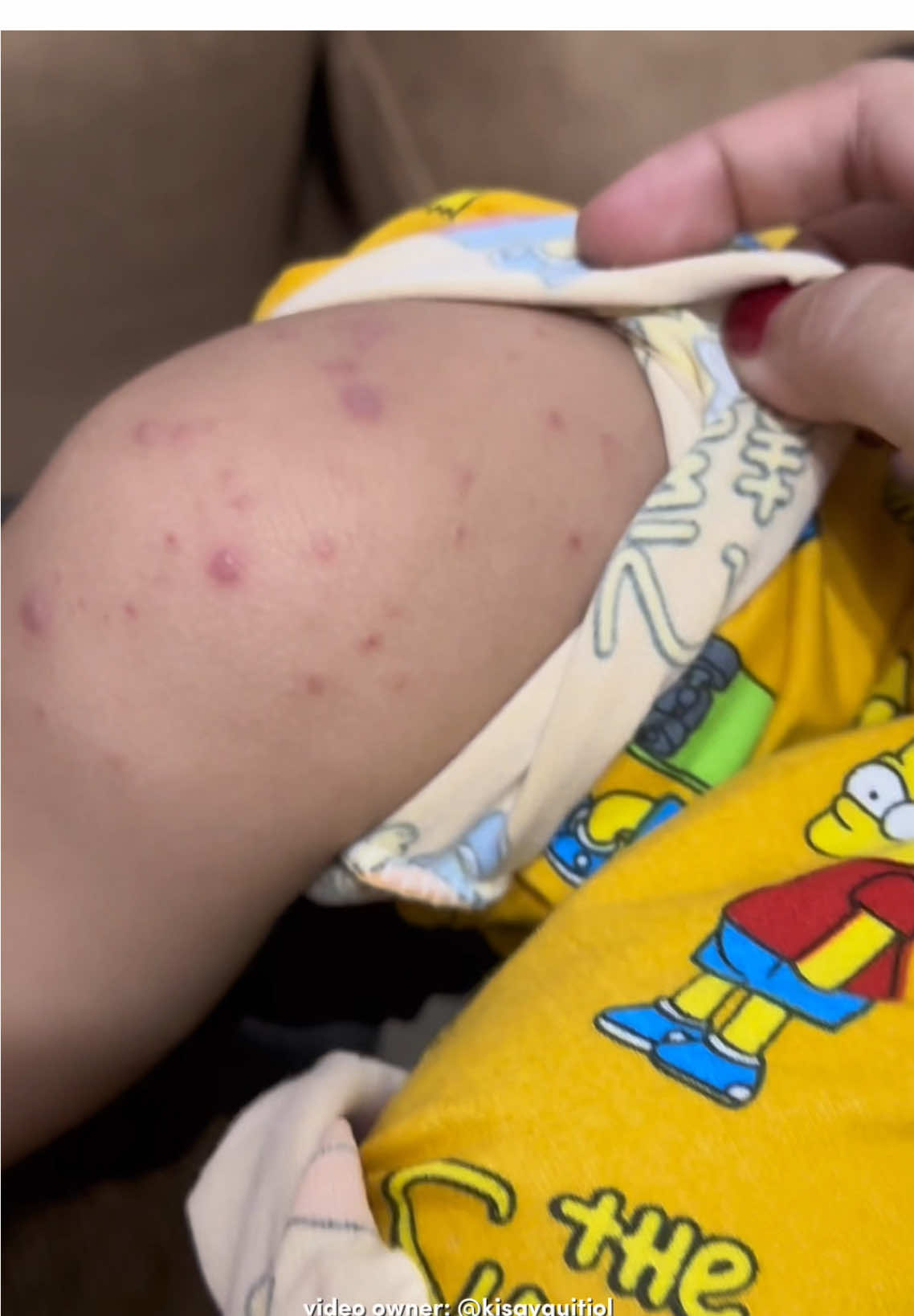 no more peklat si baby dahil sa Pure Rice Lotion ng @HEGERBABY official ❤️ #hfmdisease #hegerbabylotion #babylotion #hegerbabyricepurebabylotion #kisayvlog 