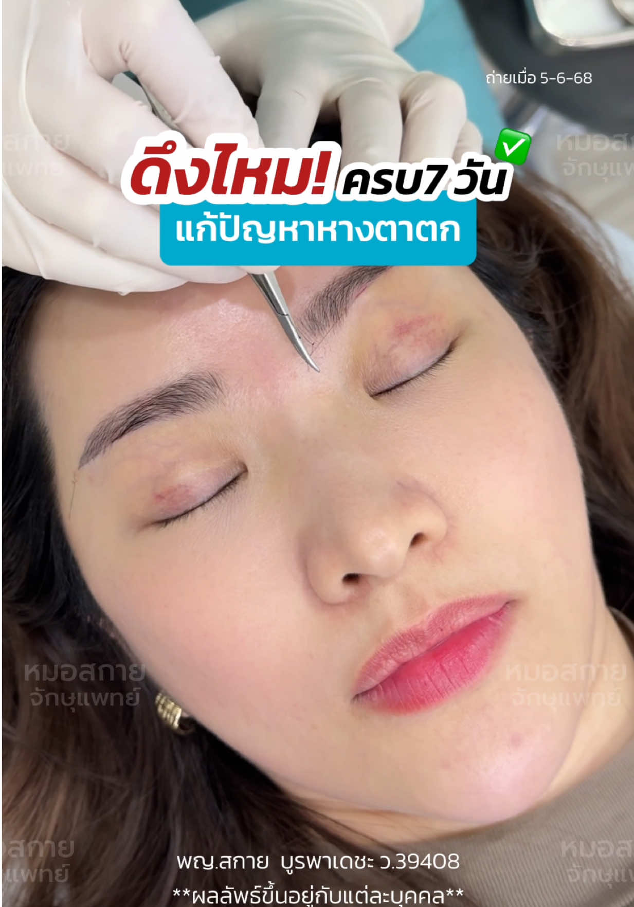 #asmr ดึงไหมครบ 7 วัน ✅ แก้ปัญหา #หางตาตก ‼️ #SubBrowLift #หมอสกาย #skyclinic