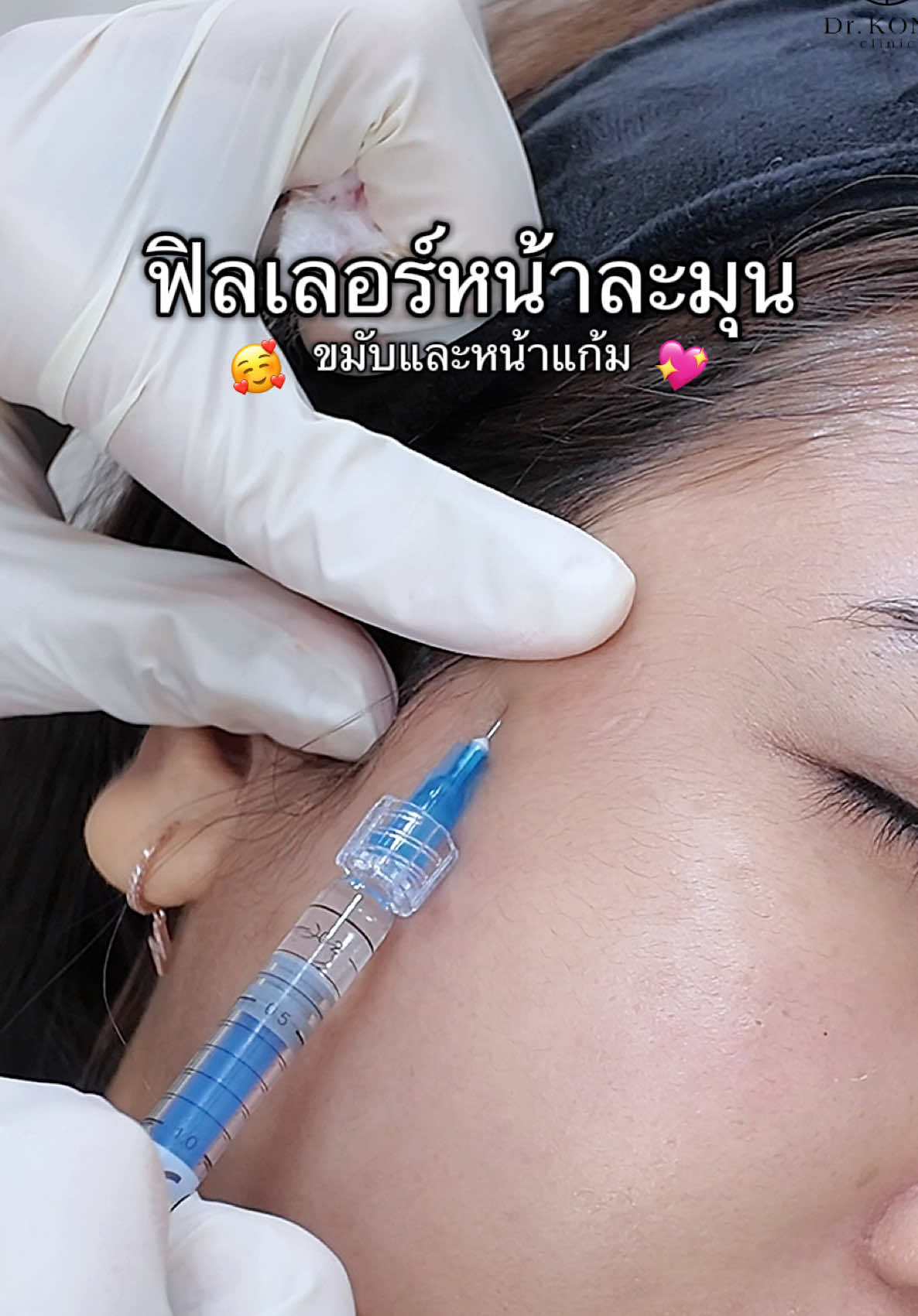 หน้าละมุนขึ้นมากก 🫣💖🤏🏻 #ฟิลเลอร์ #หน้าเด็ก #ฟิลเลอร์ขมับ #รีวิวบิวตี้   