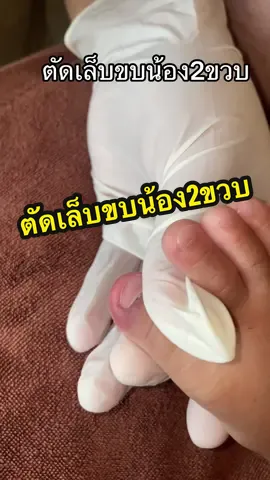 ตัดเล็บขบน้องสองขวบค่ะ#ตัดเล็บขบ #cutingrowntoenail #ตัดเล็บขบพิษณุโลก #nails #เล็บขบ 