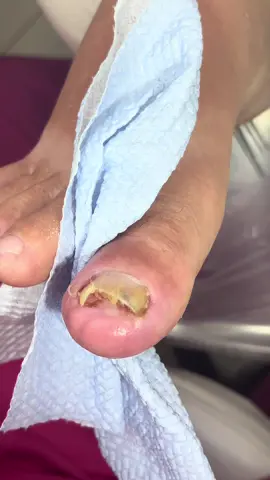 #fyp #unhaencravada #podologia #fyppppppppppppppppppppppp #viral 