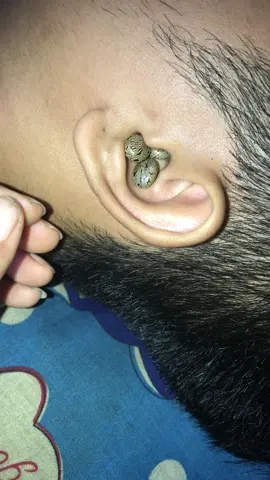 #😱 #ticks #ticksremoval #foryou #fyp 