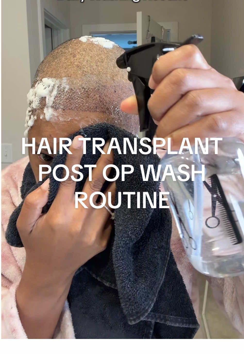 How to wash your hair After a Hair Transplant 💕 This has to be done DAILY for the first 2-3 weeks 😩 So keep that in mind when you want to keep that lil hair on the top 😂🫶🏽 Hope this was helpful 💕 #hairtransplant #femalehairtransplant #hairtransplantturkey #hairtransplantjourney #hairtransplantsurgery 