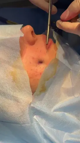 Enhance your beauty and smile with dimpleplasty. #dimpleplasty #driro #islamabad #foryoupage #foryou 