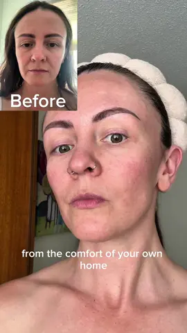 Toning and lifting my face has never been this easy All thanks to the Elvia EMS beauty device 😍✨ #beauty #skincare #fyp #grwm #ems 