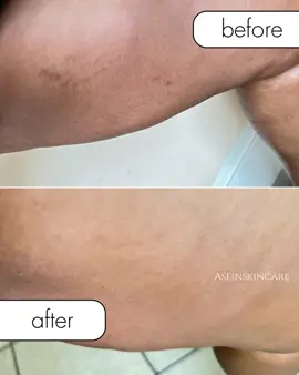 Nosso óleo para estrias será sempre imbatível!!! 😍 Veja como ele curou e eliminou as estrias do cliente e ainda uniformizou a pele dela. Nosso óleo faz maravilhas, então, se você está sofrendo com estrias de qualquer tipo, temos a melhor solução para você. 🤍 📍 Av. Eduardo Mondlane, paragem eletricidade.  Em frente à loja tem uma mesquita Maji Taqwa e com árvores de mafureira à sua esquerda #soluçaoparaestrias #tratamentoparaestrias #maputomozambique🇲🇿 #aslinskincaremz #oleoparaocorpo 