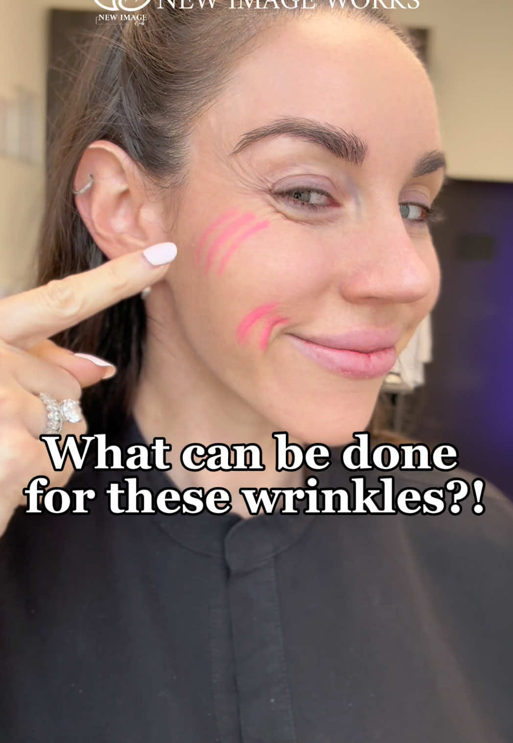 Do you have these wrinkles around the corners of mouth and cheek when smiling? Watch to learn what you can do for these… ••••••••••••••••••••••••••••••••••••••••• 📍Location: Aventura, FL 👩🏻‍⚕️Injector: Samantha, APRN Questions?! Comment below 👇🏼 ••••••••••••••••••••••••••••••••••••••••••• #miami #miamiinjector #wrinkles #wrinklereduction #antiaging                          