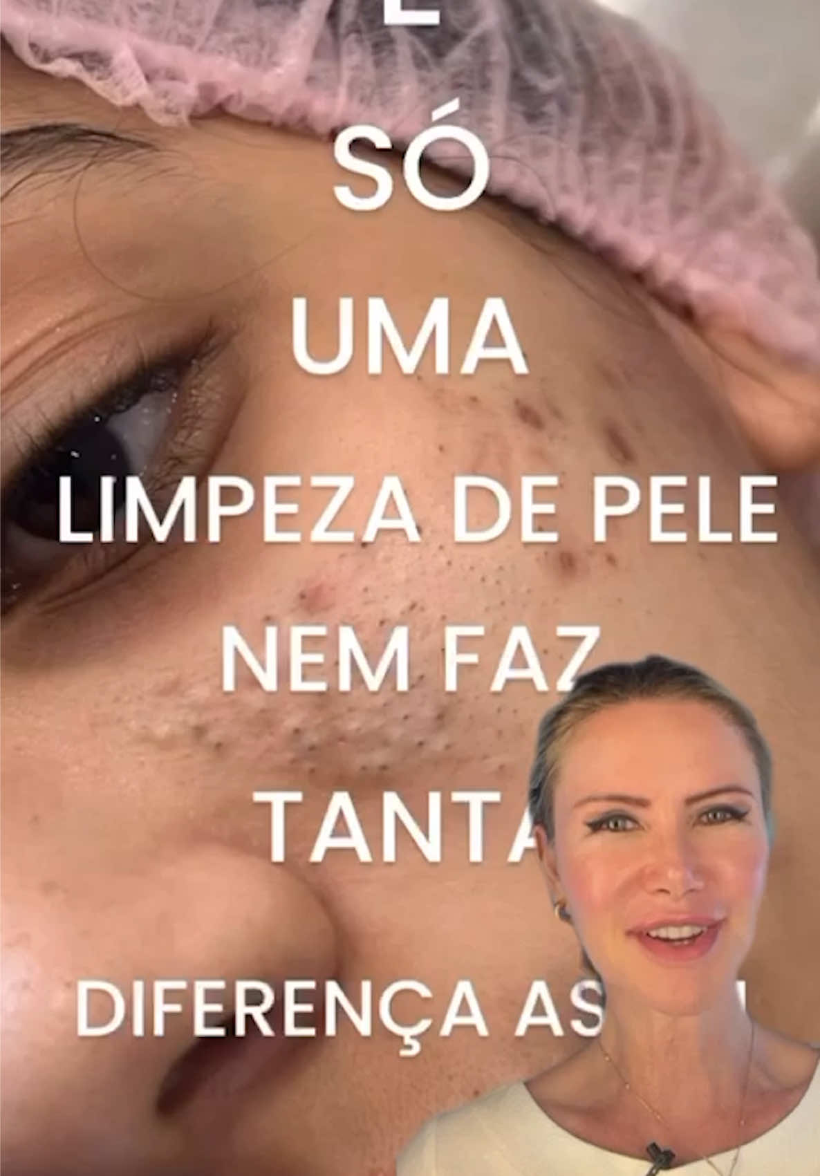 Limpeza de pele bem feita faz diferença! ⚜️A limpeza de pele é indicada principalmente para quem apresenta cravos, resultado do acúmulo de oleosidade e células mortas nos poros. Esse procedimento não serve apenas para “limpar a pele”, mas também para prevenir inflamações, melhorar a textura e potencializar a ação dos produtos usados no dia a dia. ⚜️Feita em consultório, envolve etapas de higienização, preparo da pele e extração segura, o que evita danos como manchas e cicatrizes, comuns quando se tenta espremer em casa. ⚜️A frequência ideal depende das necessidades de cada pessoa, geralmente de 30/30 dias, mas peles oleosas geralmente se beneficiam de intervalos mais curtos, enquanto outros tipos podem manter resultados por mais tempo. Sempre é importante a orientação profissional para determinar o melhor cuidado. Você já fez limpeza de pele profissional? Sentiu diferença na sua pele depois do procedimento? Créditos: kosmetololoq_turkan #limpezadepele #cravos #dermatologia #cuidadoscomapele #skincare 