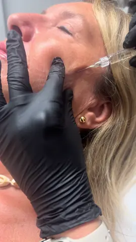 ✨ Profhilo Structura  Next Level Skin Remodelling ✨  Results are immediately after the treatment❗️ Unlike traditional fillers, Profhilo Structura isn’t about adding volume it’s about restoring and redefining. 💧 Powered by high concentration hyaluronic acid 💪 Specifically designed for deep tissue bioremodeling 🌟 Improves skin laxity, firmness & contour 🔹 Ideal for: 	•	Mid-face support 	•	Jawline definition 	•	Areas where skin has lost elasticity The result? A natural, lifted look with improved skin quality — without looking “done.” 📍 Advanced science. Subtle results. Confident you. #BeautyTrends #SkincareGoals #FreshFace #ConfidenceInSkin #SubtleEnhancement                