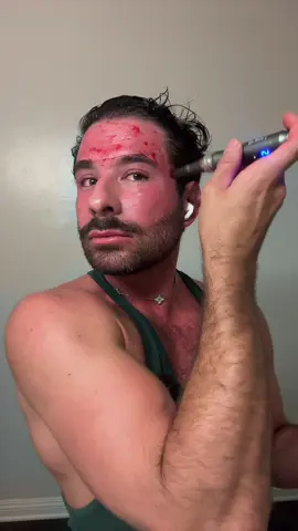 @JOVS Use code GUY130 for $130 off at checkout :) #redlight #redlighttherapy #microneedling #skincare #sandiego 