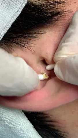 Tiếp tục xử lý mụn tai!😅#mụn #laymuntambong #binhduong #munviem @Cle’O House Bình Dương 