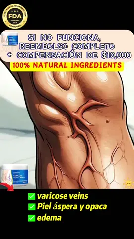 🔥Wow! Don't miss out—I found an amazing varicose vein cream that relieves leg pain, swelling, and poor circulation. It's now 50% off! Hurry and grab yours while supplies last!#varices #varicoseveins #fyp #tiktokshop #tiktokshoplabordaysale