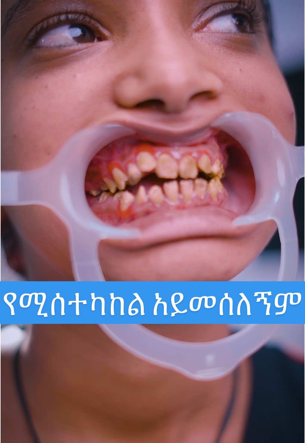smile makeover Smile design veneer #creatorsearchinsights2025 #veneer #zirconia #zirconiacrown #zirconiabridge  