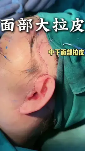 #面部提升 #抗衰逆龄 #微調 #變美 #整形 