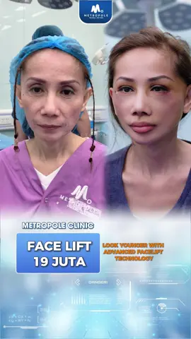 Datanglah ke klinik kami dan anda akan mendapatkan perawatan kecantikan dengan hasil yang maksimal dan memuaskan 😍✨ Hubungin kami untuk informasi lebih lengkap !  #metropoleclinic Metropoleclinic #metropole #rhinoplastyjakarta #operasi #facelift             