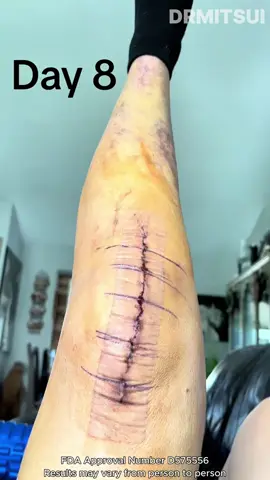 💥 Joint pain? This patch STOPS it in one move! 🔥#PainPatch #HealthyLiving #pain #DRMITSUI #ZL