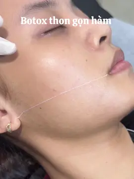 Botox thon gọn hàm, nhanh an toàn, không nghỉ dưỡng #botox #filler #thongonham 