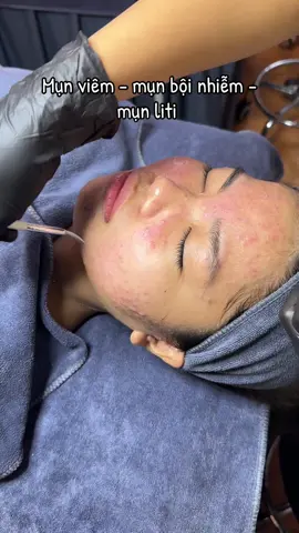 Mụn viêm , mụn viêm bội nhiễm , mụn liti zô xem nha mí bà #duocmypham #spabacninh #spauytin #trimun #munviem 